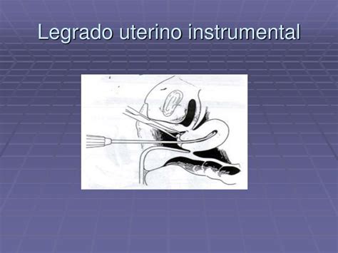 Dilatación y legrado fraccionados fractional dilatation and curettaje. PPT - SANGRADOS I TRIMESTRE DEL EMBARAZO PowerPoint ...