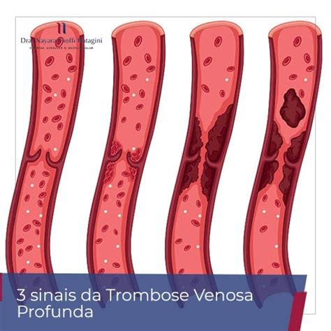 Oct 23, 2017 · renal vein thrombosis (rvt) is a blood clot that develops in one or both of the renal veins. 3 Sinais Típicos de Trombose Venosa Profunda | Dra. Nayara ...