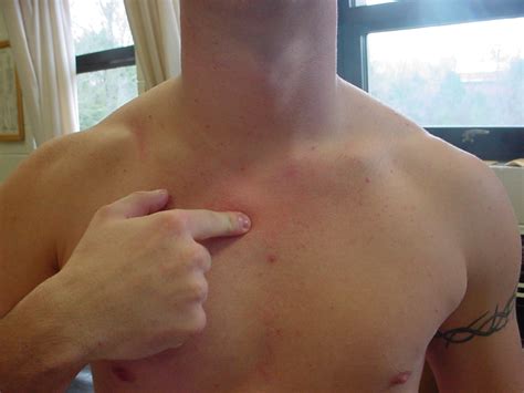 To avoid the formation of a clavicle bone lump, a sling can be used to help the bone heal properly. Manubrium Location