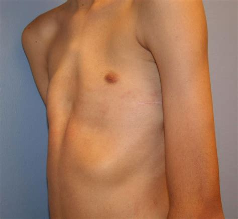 The main symptom of pectus carinatum is a breastbone that sticks out. Triple X Syndrome - Causes, Symptoms, Treatment