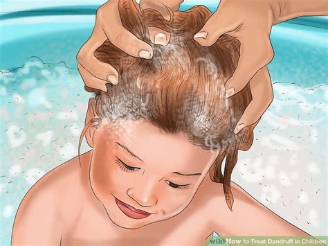 Knot no more doesn't cause any build up. 3 Ways to Treat Dandruff in Children - wikiHow