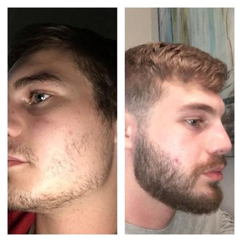 Like with any drug, there's possible side effects when using minoxidil for beard growth stimulation. Minoxidil Before And After Beard Result / Its use requires patience and dedication to see the ...