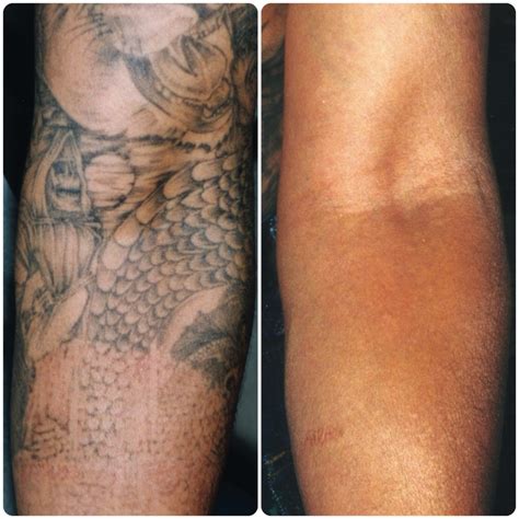 We can treat professional tattoos, amateur tattoos, traumatic tattoos and cosmetic tattoos. Used Cynosure Hoya ConBio RevLite Aesthetic Equipment For Sale