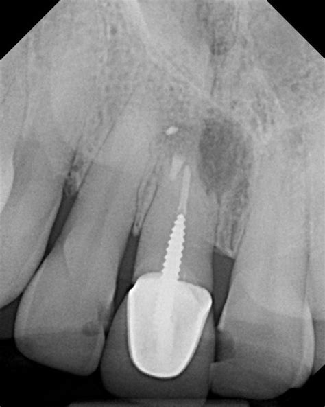 Check spelling or type a new query. Root Canal Apicoectomy Failure - Relation to Dental ...