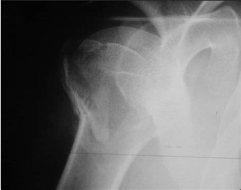 Functional outcome following proximal humeral interlocking ...