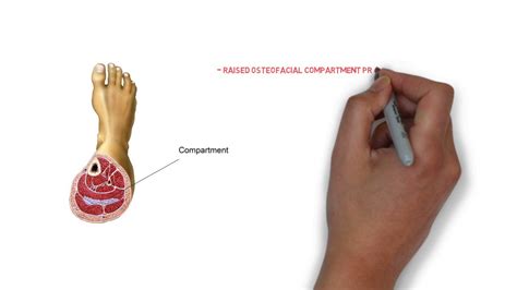 Complications of fractures - YouTube