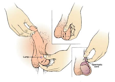 Common early symptoms of throat cancer might include: Testicular lump | The British Association of Urological ...