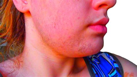 However, the benefits are also greater with the higher dose. home remedies for unwanted facial hair - YouTube