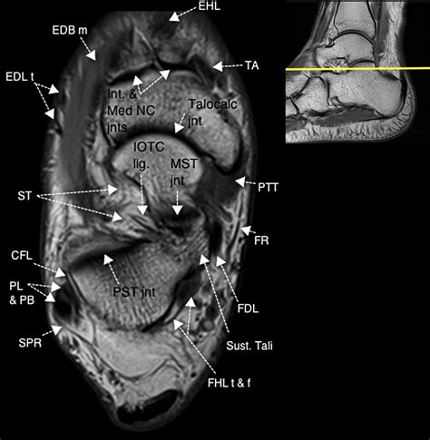 They are individual positioned medial to their respective tendon of the flexor digitorum longus. Normal Magnetic Resonance Imaging Anatomy of the Ankle & Foot - Magnetic Resonance Imaging Clinics