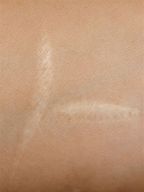 Maybe you would like to learn more about one of these? Scar Camouflage | Skin Tone Tattooing