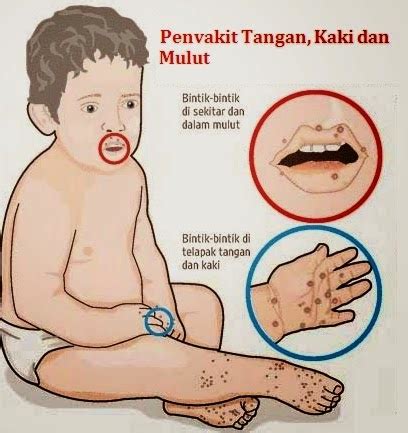 Simptom dan tanda tanda penyakit kaki, tangan dan mulut. Pengedar Shaklee: Tanda Dan Langkah Pencegahan Untuk ...