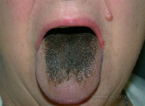 See what gary (garyandbuddy) has discovered on pinterest, the world's biggest collection of ideas. Black hairy tongue - Pictures, Symptoms, Causes, Treatment