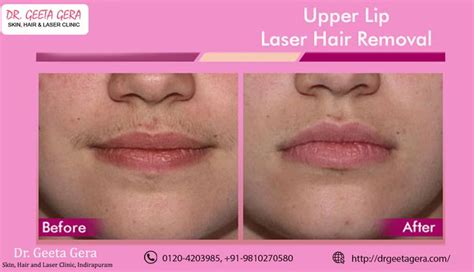 The trick is to seek laser removal for the right type of hair, at the right time. Upper Lip Laser Hair Removal Permanent Solution. # ...