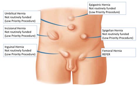 Groin lump in women may be hard or movable depending on the underlying cause. Unilateral Inguinal Hernia With Obstruction - Carles Pen