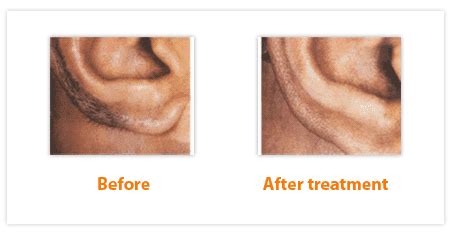 Why we recommend laser hair removal for the ears. Male Ear and Nose Hairs - City Laser Clinic | Laser Hair ...