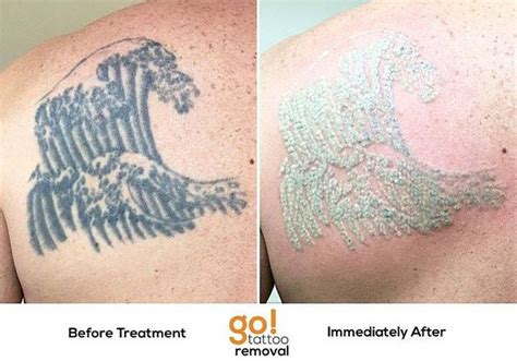 The salt scrub removal works by attempting to remove the layers of the skin to reach the tattoo. Laserless Tattoo Removal - tattoo removal #tattooremoval #tatoo | Tattoo removal, Homemade ...