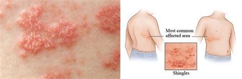 Pictures of herpes reveal a range of symptoms. Can anyone tell me what this is? It's on my waistline and ...