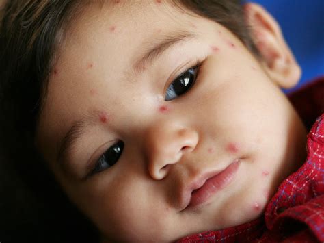 Yang menimbulkan gejala seperti bintik merah berisi nanah sakit d sekitar kemaluan dan sudah sangat menyiksa sekali rasanya. Cara Mengatasi Bintik Merah Pada Kulit Bayi Agar Sehat ...