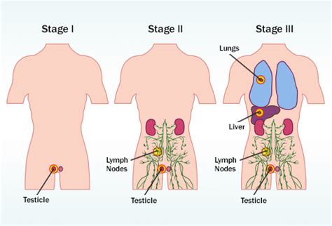 A swelling and/or lump in one or both of the testes. Testicular Cancer: Signs, Symptoms, Risk Factors, Stages ...