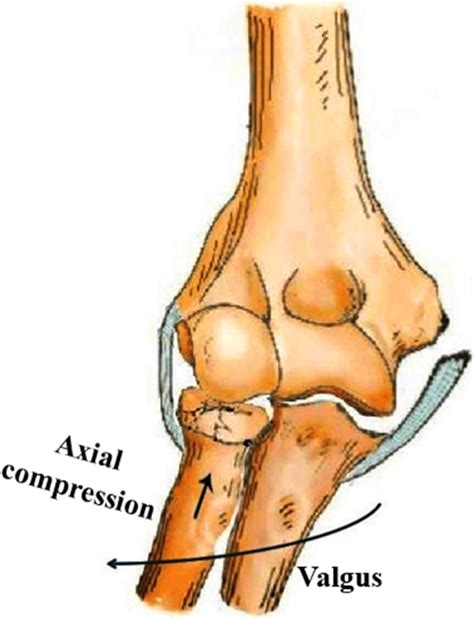 Severe traumatic valgus instability of the elbow ...