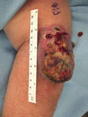 Merkel cell carcinoma (mcc) is a rare, aggressive form of skin cancer with a high risk for returning (recurring) and spreading (metastasizing), often within two to three years after initial diagnosis. Merkel Skin Cancer : Educational Video Series: What is ...