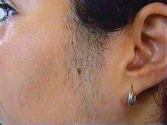 What causes ingrown hair on scrotum? laser hair removal nyc: What You Ought To Know About Hair ...