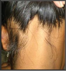 Traction alopecia may present in an ophiasis pattern from hair care practices. Alopecia Ophiasis - UK Hair Consultants