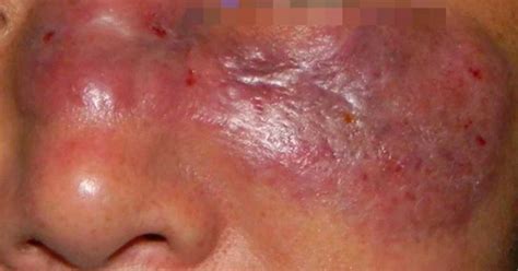 La rápida propagación de esta infección se atribuye al uso incontrolado de esteroides para tratar a los pacientes con coronavirus. Enfermedad Del Hongo Negro / Hongo negro: Irak registró ...