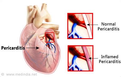 • acute coronary syndrome • acute pericarditis • acute respiratory distress. Way out here: Pericarditis*