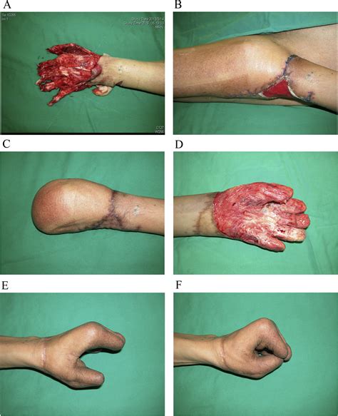 One-stage debulking procedure after flap reconstruction for degloving ...