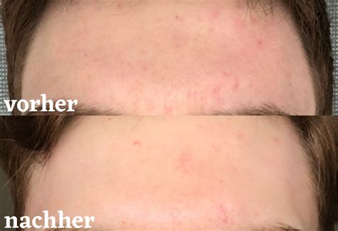 Da ist man froh, dass hautunreinheiten endlich abgeklungen sind, doch dann bleiben dunkle flecken und kleine narben. Pickelmale loswerden: So geht's! - Beauty Report