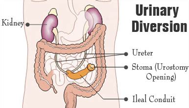 Our team of highly experienced experts such as medical oncologist dean bajorin provide specialized treatment to people with bladder cancer. How long can you live without a bladder? - Quora
