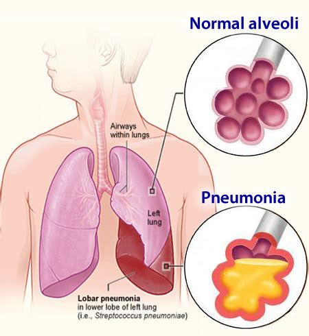 Penyakit ini bisa muncul karena di akibatkan oleh virus, bakteri, jamur maupun parasit yang dimana pulmonary alveolus (alveoli) yang bertanggung jawab untuk menyerap oksigen dari atmosfer menjadi. Paru - Paru Berair : Punca dan Cara Kembali Pulih - Story ...