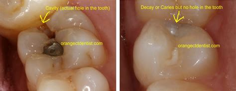 How to regrow teeth, regenerate teeth, heal teeth, heal cavities, and reverse periodontal decay. Difference between decay and a cavity | Dental decay ...