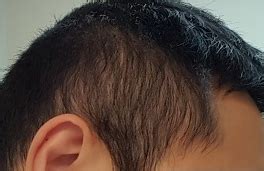 Diffuse thinning is so sad and funny at the same time. Thinning on the sides and back. Do I have DUPA (Photo)?