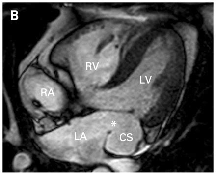 Coronary artery anomalies were found in 1,686 patients (1.3% incidence) undergoing coronary arteriography at the cleveland clinic foundation from 1960 to 1988. Magnetic resonance imaging of unroofed coronary sinus | Heart