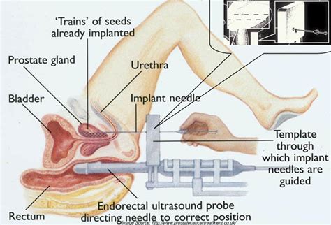 Prostate massage might ease swelling in the area so it could put less pressure on the urethra. Transperineal Biopsy results in risk of Erectile Dysfunction