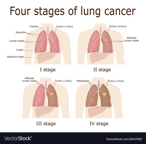 In stage 1 lung cancer, people usually do not experience symptoms. Four stages of lung cancer Royalty Free Vector Image