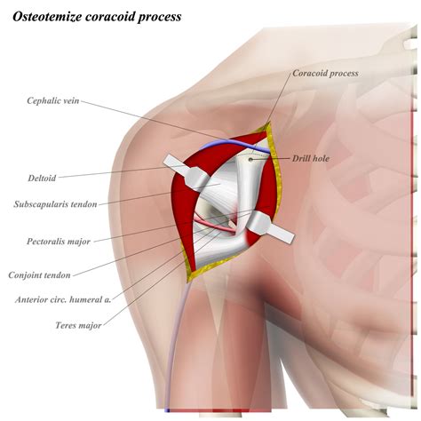 Tendons are situated between bone and muscles and are bright white in colour. Shoulder Tendon Anatomy / Shoulder - Wikipedia : The ...