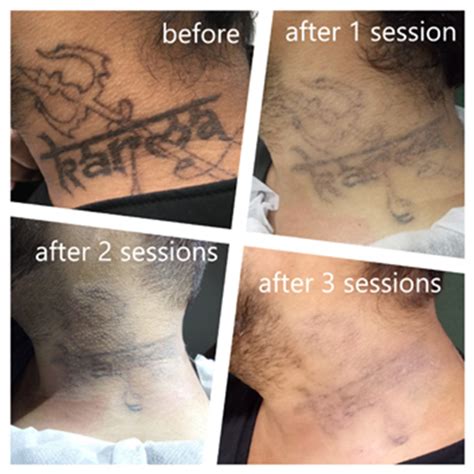 And while it might be difficult to notice significant changes at first, a comparison between photographs taken during previous visits can reveal the true extent of progress. Laser Tattoo Removal Treatment - Orchid Cosmetic