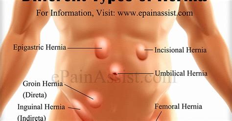 Masuk angin itu hanya sebutan orang indonesia bagi kumpulan gejala tadi, kata dr. Tahukah Anda?: Hernia (Angin Pasang)