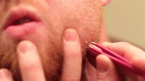 (yay.) which is why, like a pimple, it's tough to ignore an. Ingrown Hair - YouTube