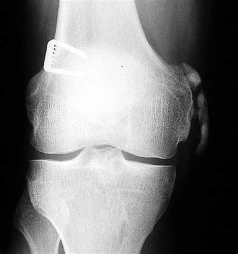 There is evidence of osteoarthritis. The Pellegrini-Stieda lesion. Ossification along the ...