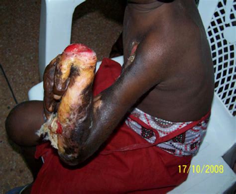 The condition is rare in the 6 world health organization, buruli ulcer: Contracture from Buruli ulcer, showing mul- tiple joint ...
