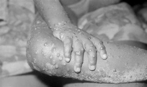 Monkeypox, which is closely related to smallpox, has spread throughout west and central africa over the last 10 years. Alarm as deadly monkeypox virus comes to Britain | UK ...