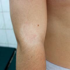 This is then followed, days to weeks later, by a rash of many similar but smaller round or oval lesions, mainly on the trunk and upper limbs. Pitiriasi alba: non è contagiosa e guarisce spontaneamente ...