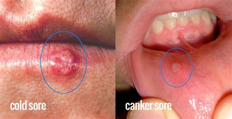 A compromised immune system, or if you are undergoing chemotherapy or taking medication that weakens your immune. Cold Sores Vs. Canker Sores. How to tell the difference ...