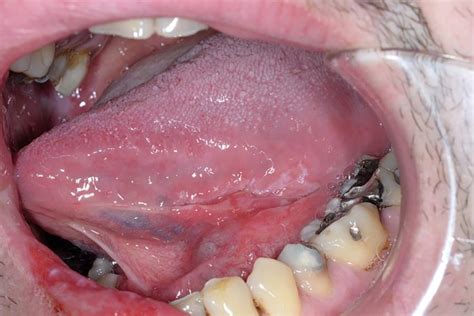 Syphilis — a sexually transmitted bacterial infection — develops in stages, and symptoms vary depending on the stage of the disease you have. Oral syphilis - A case report : Scottish Dental magazine