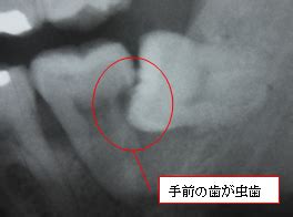 Jan 01, 2017 · 印象をとって作製した技工物などを歯に装着する治療のことを、セットといいます。 step3では、さまざまな技工物のセットについて、詳しく説明します。 第8章 c2の治療 step1 crstep2 インレーstep3 セット 1．セッ 第四回 親知らずの話 | 西宮市高松町の歯医者、西宮駅北口徒歩2 ...