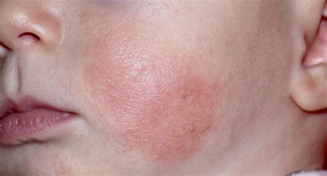 Eczema describes skin conditions that cause the skin to become itchy, red, inflamed and cracked. Baby eczema: causes, symptoms, treatments and creams ...